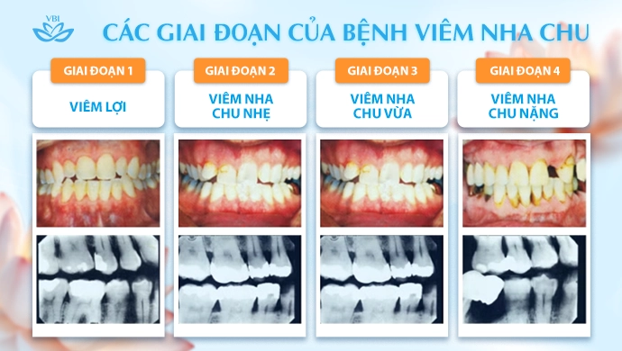 4-giai-doan-tien-trien-cua-benh-viem-nha-chu