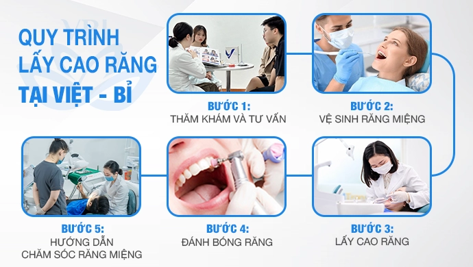 quy-trinh-lay-cao-rang-tai-nha-khoa-viet-bi