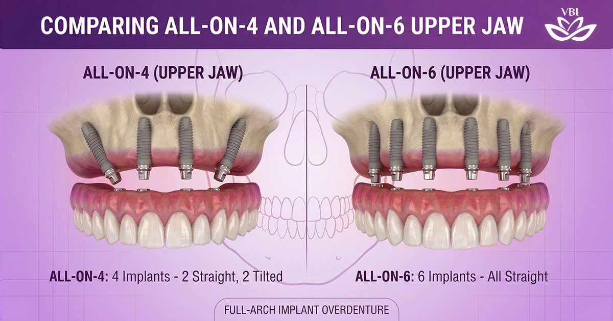 All-on-4 vs All-on-6 Dental Implants: Which is Right for You?