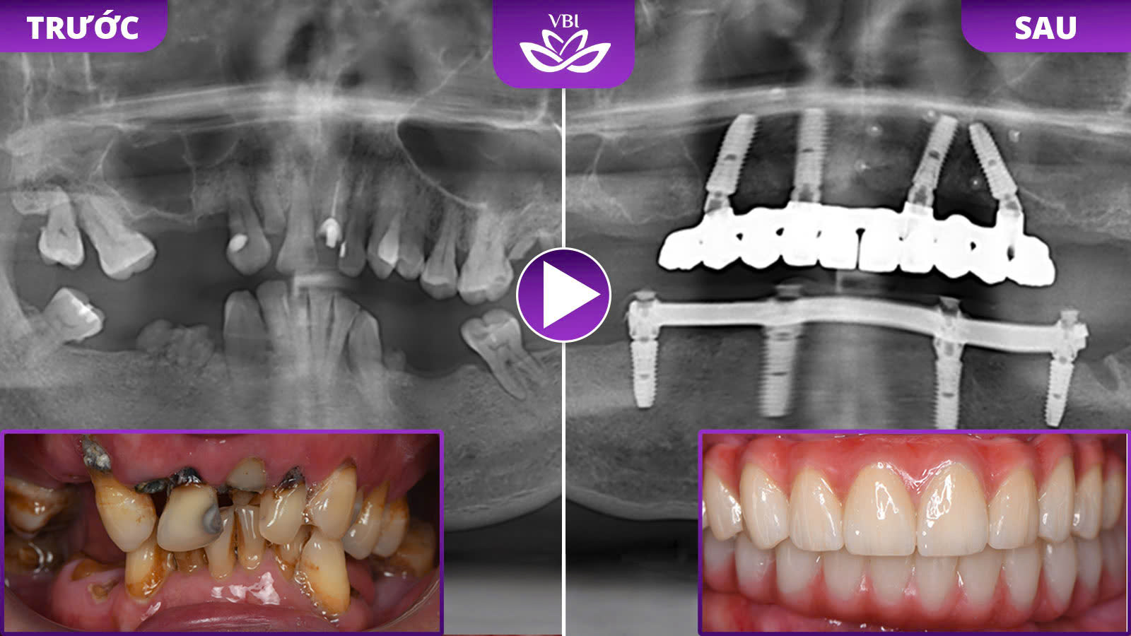 full mouth dental implants in Hanoi