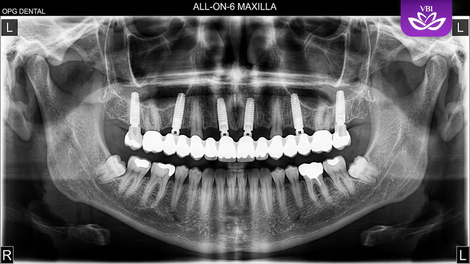 all on 4 vs 6 implants upper jaw x-ray