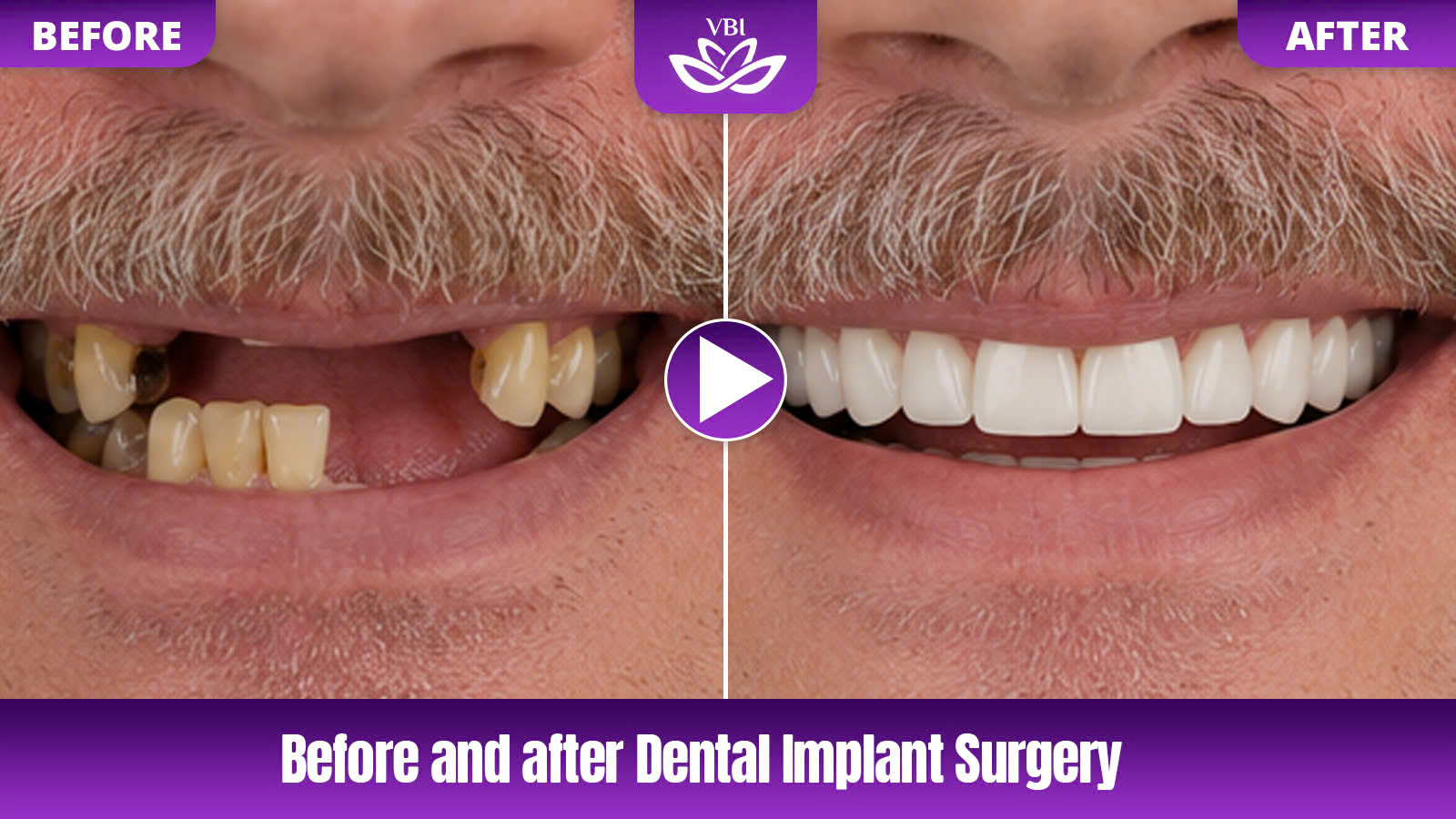 vietnam dentist reviews detailing before and after dental implant results and smi - Before-After-1
