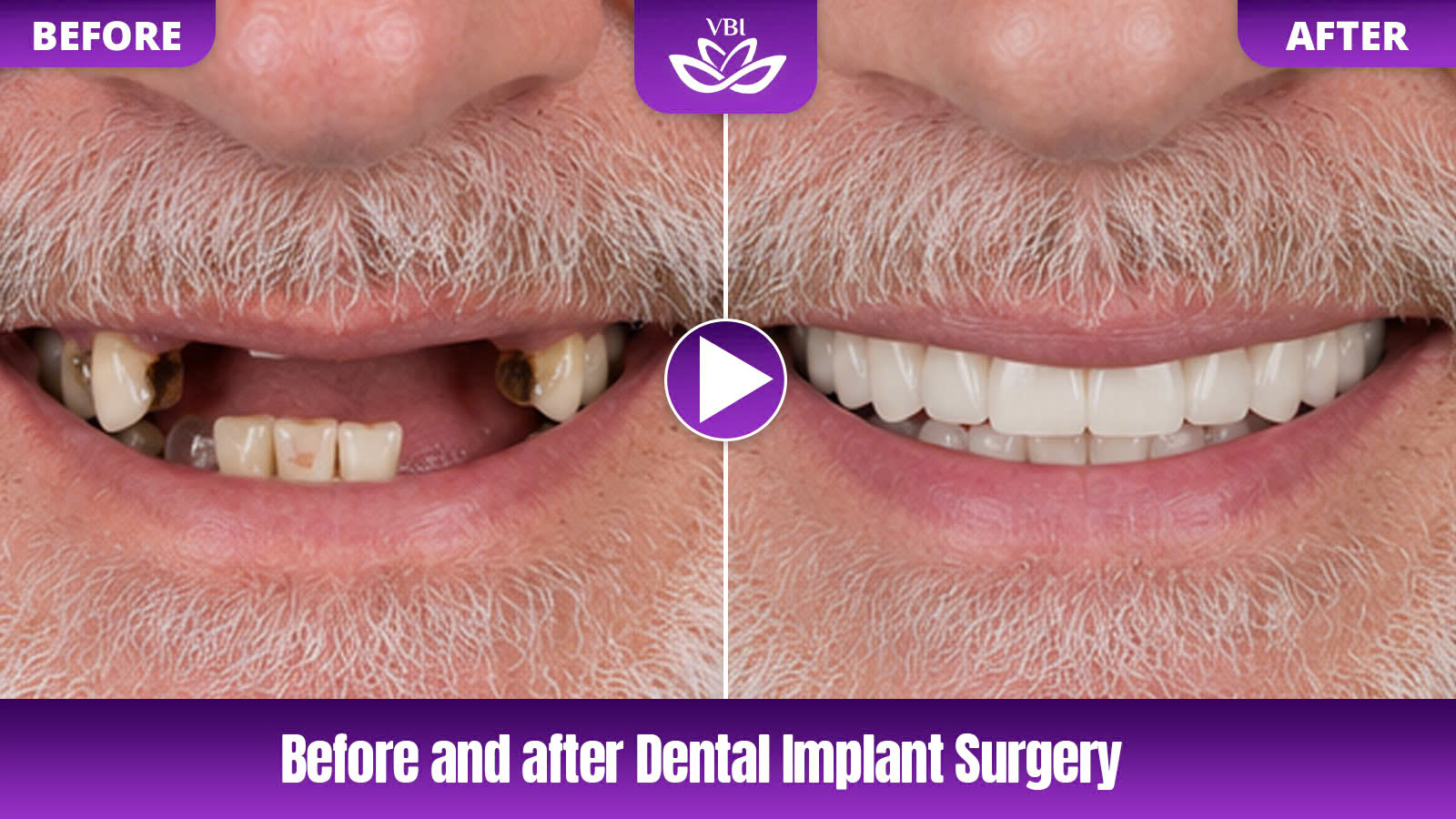 vietnam dentist reviews detailing before and after dental implant results and smi - Before-After-2