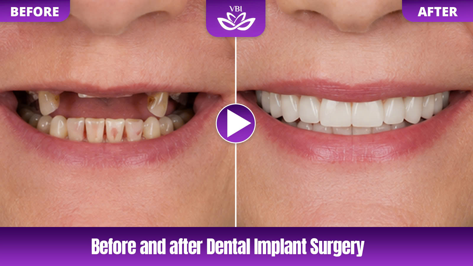 vietnam dentist reviews detailing before and after dental implant results and smi - Before-After-3
