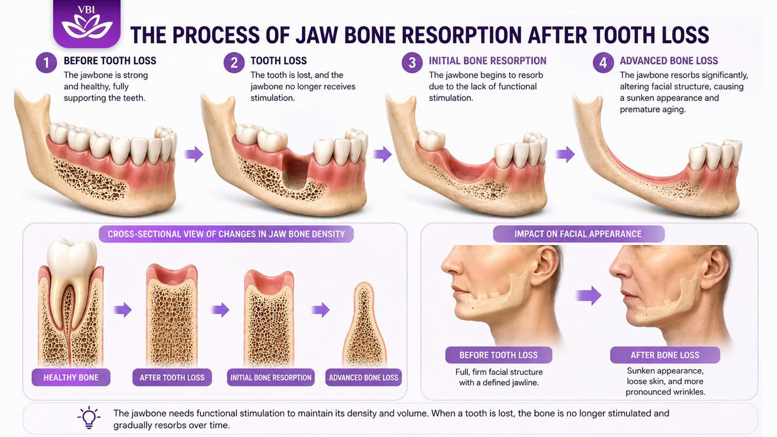 3D graphic showing the bone resorption process before a bone graft for dental implants