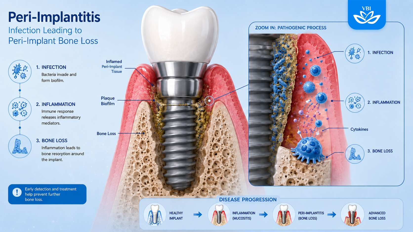 3D medical illustration of bacteria causing bone loss and early dental implant failure symptoms