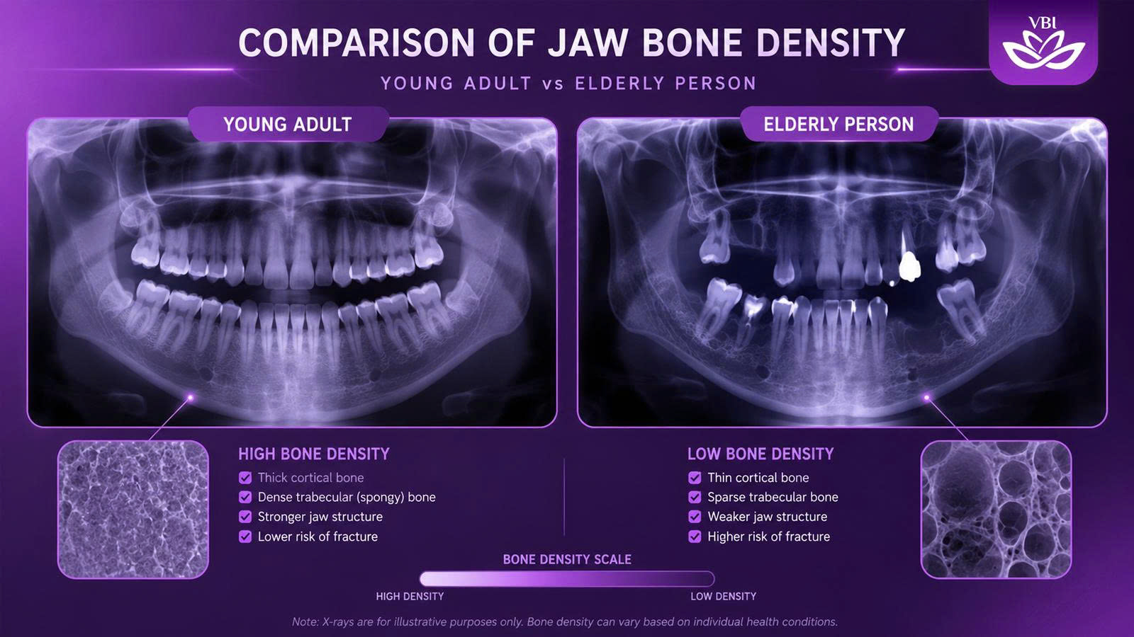 Bone density challenges X-ray comparison for teeth implants for seniors