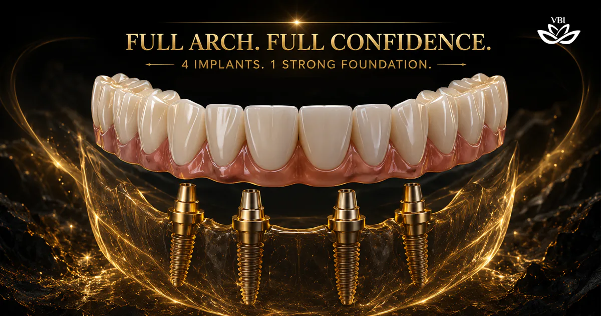 All-on-4 Dental Implants Cost in Vietnam: Ultimate Pricing Guide