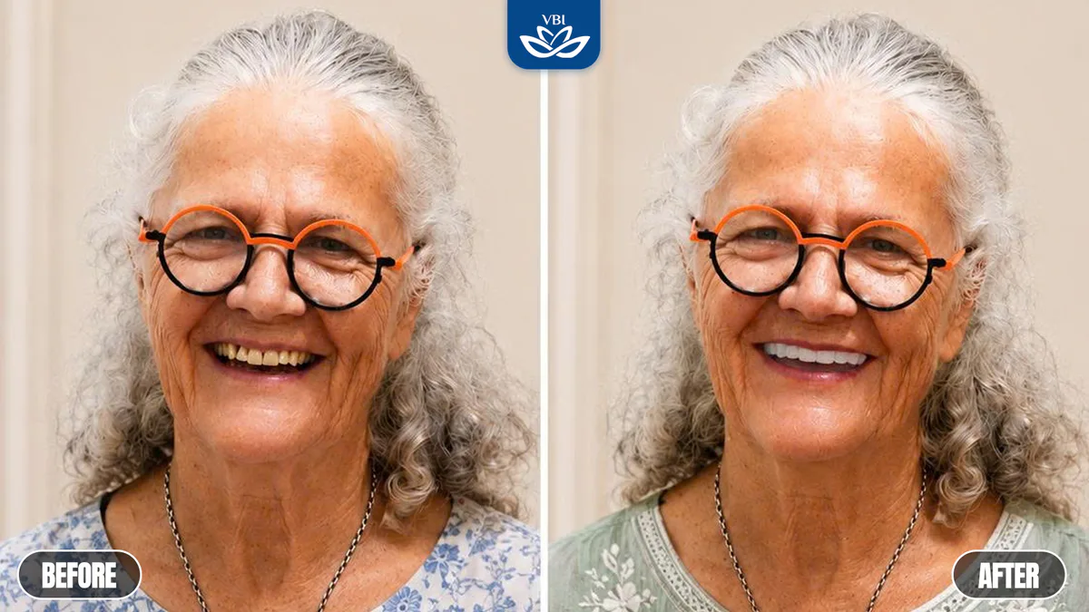 Before and after dental photo showing a full-mouth porcelain crown rehabilitation for an Australian patient at Viet Bi Premium Clinic | Vietnam dentist reviews