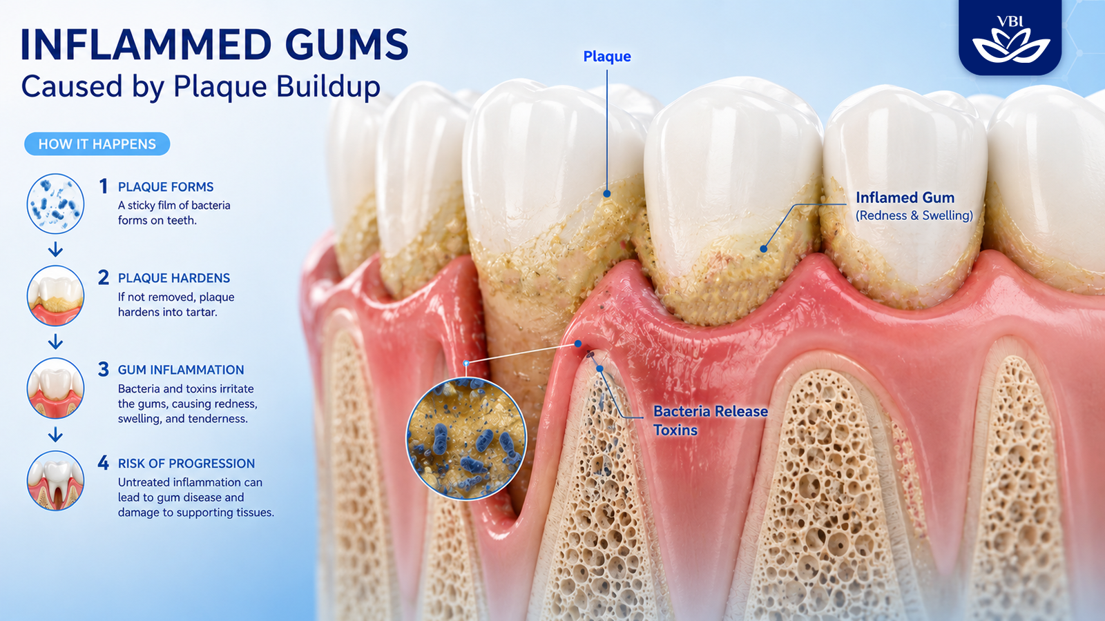 Graphic illustration of inflamed gum structure due to plaque buildup